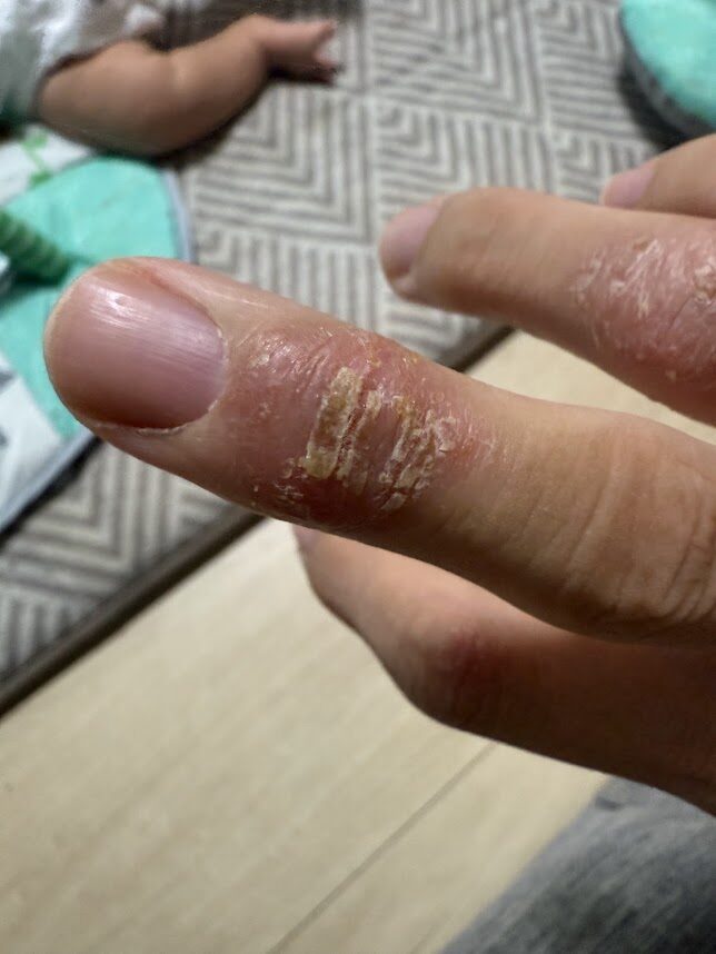 脱ステ